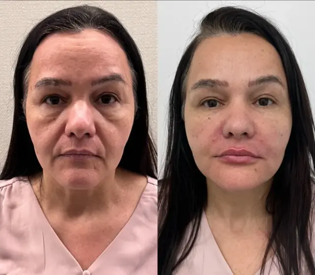 Antes e depois de rejuvenescimento facial em paciente mulher, vista frontal