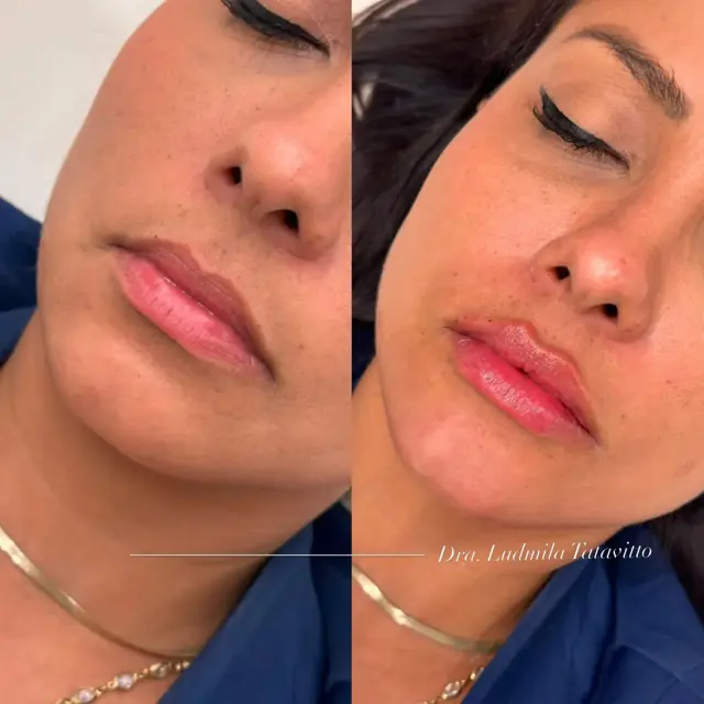 Antes e depois de lábios com contorno definido