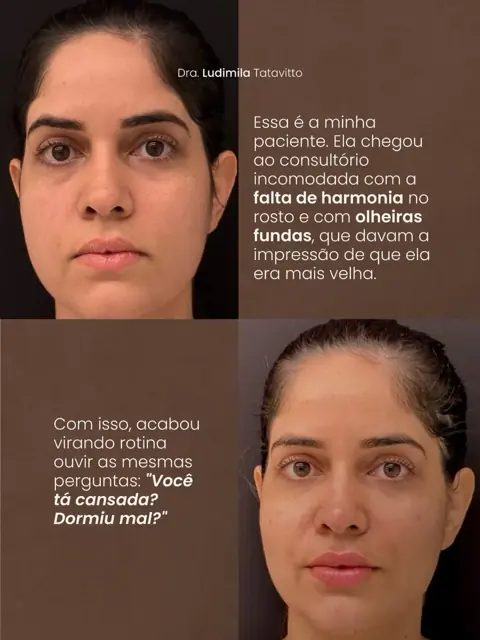 Antes e depois de tratamento de olheiras fundas