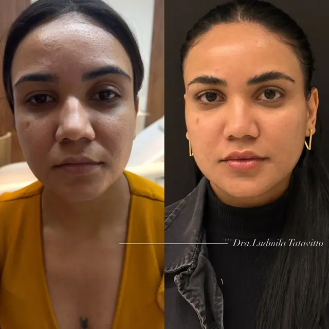 Antes e depois de harmonização facial completa em paciente mulher