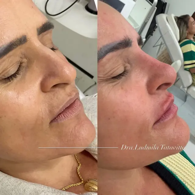 Antes e depois de lábios e região perioral, vista de perfil